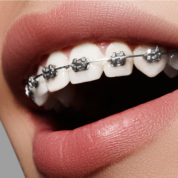 brakets- clínica dental