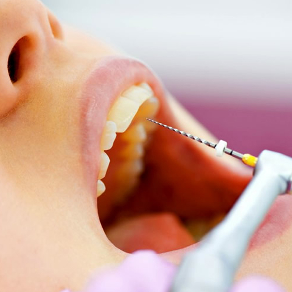 Endodoncia en la clínica dental