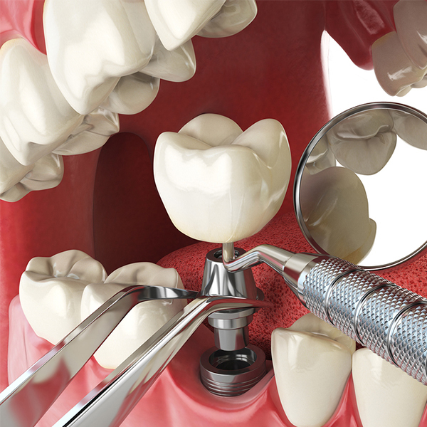 dentista-implante
